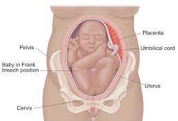 Medical illustration of a breech presentation, showing a baby in the womb positioned with its buttocks or feet facing downward toward the birth canal. The image includes a cross-sectional view of the mother's abdomen, clearly depicting the baby's position relative to the uterus, pelvis, and birth canal. Anatomical details such as the placenta and umbilical cord are also visible, designed for educational purposes.