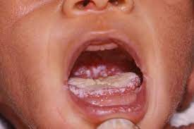 Baby with mouth lesions experiencing discomfort due to Mouth Problems