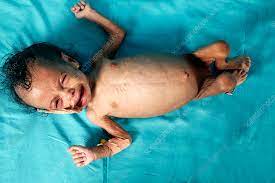 A visibly distressed child with failure to thrive, lying on a green cloth and crying.