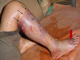 Symptoms of a snake bite: pain, swelling, redness