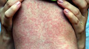 Skin Rash Caused by Atopic Dermatitis