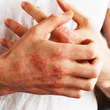 Individual with itchy hands and rash