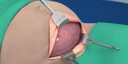 Cesarean birth process