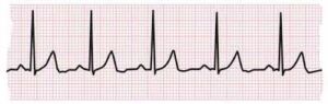 An electrocardiogram (ECG or EKG) reading showing electrical activity in the heart, crucial for diagnosing heart problems like heart attacks 