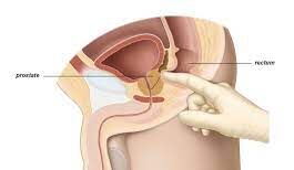 Medical professional conducting digital rectal exam for prostate assessment