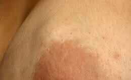 An illustration or image depicting a lump in the breast, highlighting an abnormality or mass. The area of concern is subtly marked or emphasized to raise awareness about breast health. The surrounding tissue is shown for context, with clear visuals of the lump's size and location, aiming to inform and educate about potential signs of breast conditions.