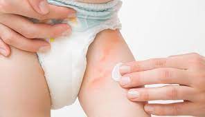 Hands carefully applying diaper rash cream to the irritated skin on a baby’s left leg.