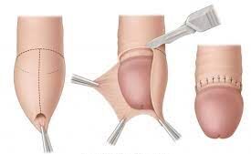 Close-up of a circumcision being conducted with proper medical equipment.