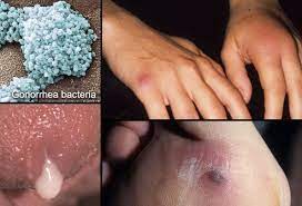 Microscopic view of Chlamydia trachomatis bacteria, the causing agent of Chlamydia and graphic depiction of symptoms of Chlamydia: discomfort during urination, abnormal vaginal discharge, and pelvic pain