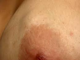 Image depicting a lump in the breast