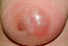 Illustration of a breast abscess, emphasizing essential breastfeeding tips for new moms.