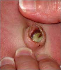Infected umbilical cord stump in newborn baby