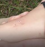 puncture wounds to an arm