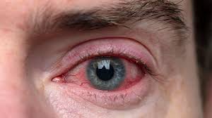 A close-up image of a human eye showing red-eye, with the pupil appearing bright red and the surrounding white of the eye showing signs of irritation or blood vessels.