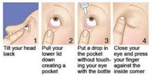 Step-by-step technique for using eye drops: tilting head back, pulling down the eyelid, and administering a drop into the eye.