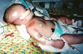 Shaken baby syndrome - Child hospitalized with severe injuries connected to hospital equipment