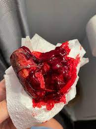 Products of conception on a tissue paper indicative of a miscarriage