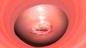 The infected opening of the uterus: possible cervical cancer