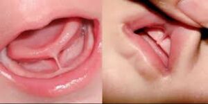 A close-up view of a baby’s mouth showing a tongue-tie, where the lingual frenulum is shortened.
