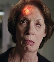 Stroke Prevention: Woman with Facial Drooping