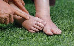 A person gently touching their very edematous feet, which appear swollen and inflamed. The skin is stretched and shiny, with visible puffiness around the ankles and toes. 