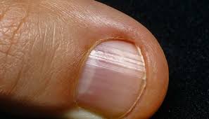 Close-up illustration of a fragile fingernail, showing a cracked or chipped nail that appears weak and delicate. The nail is slightly bent or peeling at the edges, with subtle details emphasizing its fragility. 
