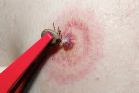 Tick being removed with tweezers 
