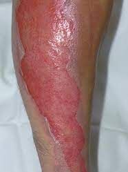 Second degree burn on leg - wound care