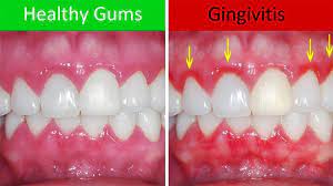 A comparison of healthy gums versus gums affected by gingivitis, highlighting the redness and swelling.