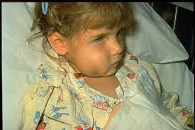 Child displaying symptoms of Hemophilus influenzae infection due to lack of immunization