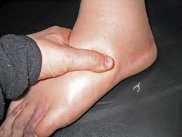 Person with marked swelling to their foot