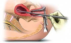 Process of a D&C (Dilation and Curettage) after a miscarriage