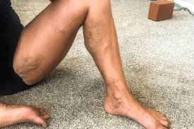 An image of a person's leg showing varicose veins. The veins are enlarged, twisted, and blue or purple in color, visible along the skin surface, typically on the lower leg. The surrounding skin appears normal, with the veins standing out due to their abnormal appearance.