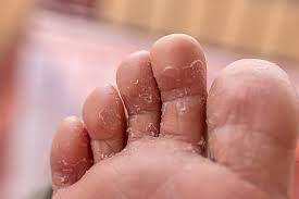 Image of athlete’s foot rash between toes