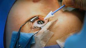 Surgical procedure to address cataracts and restore eye health