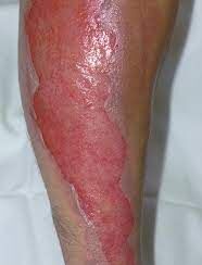 a second-degree burn on a leg, shown in a neutral medical setting.
