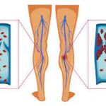Diagram depicting a blood clot in the leg vein