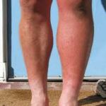 Individual experiencing Deep Vein Thrombosis 