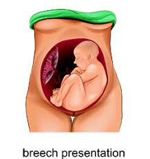 An image showing a cross-section of a baby in a breech position inside the womb. The baby is positioned with its head up and feet down, surrounded by amniotic fluid and the uterine wall. The womb is depicted with soft, anatomical details, highlighting the baby's position and the surrounding environment.