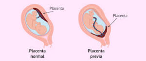 An illustration showing a side-by-side comparison of normal placental implantation and placenta previa. On the left, the placenta is positioned correctly at the top of the uterus, away from the cervix. On the right, the placenta in placenta previa partially or completely covers the cervix, illustrating the condition. The images are labeled and color-coded for clarity, with a cross-sectional view of the uterus.