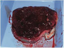 An image of a placenta with visible signs of abruption. The placenta has darkened, clotted areas indicating bleeding. Surrounding tissue shows irregularities consistent with the condition, captured in a clinical or medical setting for diagnostic purposes.