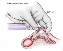 Man undergoing receiving analgesia to the penis before the procedure