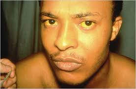 Man exhibiting jaundice with yellow eyes and skin