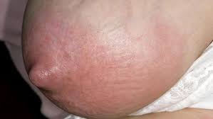 An engorged breast showing swollen and enlarged tissue, with visible veins and skin stretched tightly over the surface.