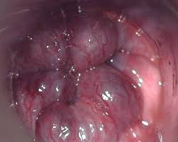 Close-up image illustrating hemorrhoids, swollen veins around the anus or in the rectum. They may appear as swollen, bulging lumps, sometimes with a bluish tint, and can cause discomfort or pain.