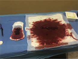Blood-soaked pad and mackintosh after delivery - Managing postpartum discomforts