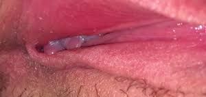 Image of a red vulvar area, potentially indicating inflammation or irritation