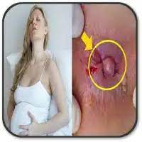 On the left, a woman appears uncomfortable, holding her lower abdomen or sitting in a distressed posture, reflecting discomfort. On the right, an illustration of a small external hemorrhoid is shown, appearing as a swollen, tender bump near the anal area, highlighting the condition in a medical context.