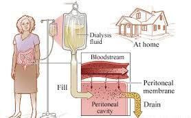Peritoneal Dialysis Setup: Catheter and Dialysis Fluid Bags
