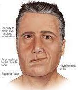 Strokes: Close-up photograph focusing on facial expressions to depict asymmetry, a potential stroke sign.